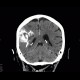Oligodendroglioma of parietal lobe: CT - Computed tomography